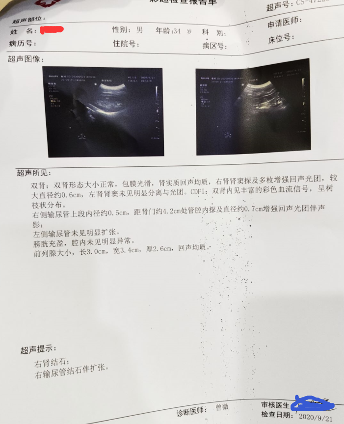 肾结石CT报告图片