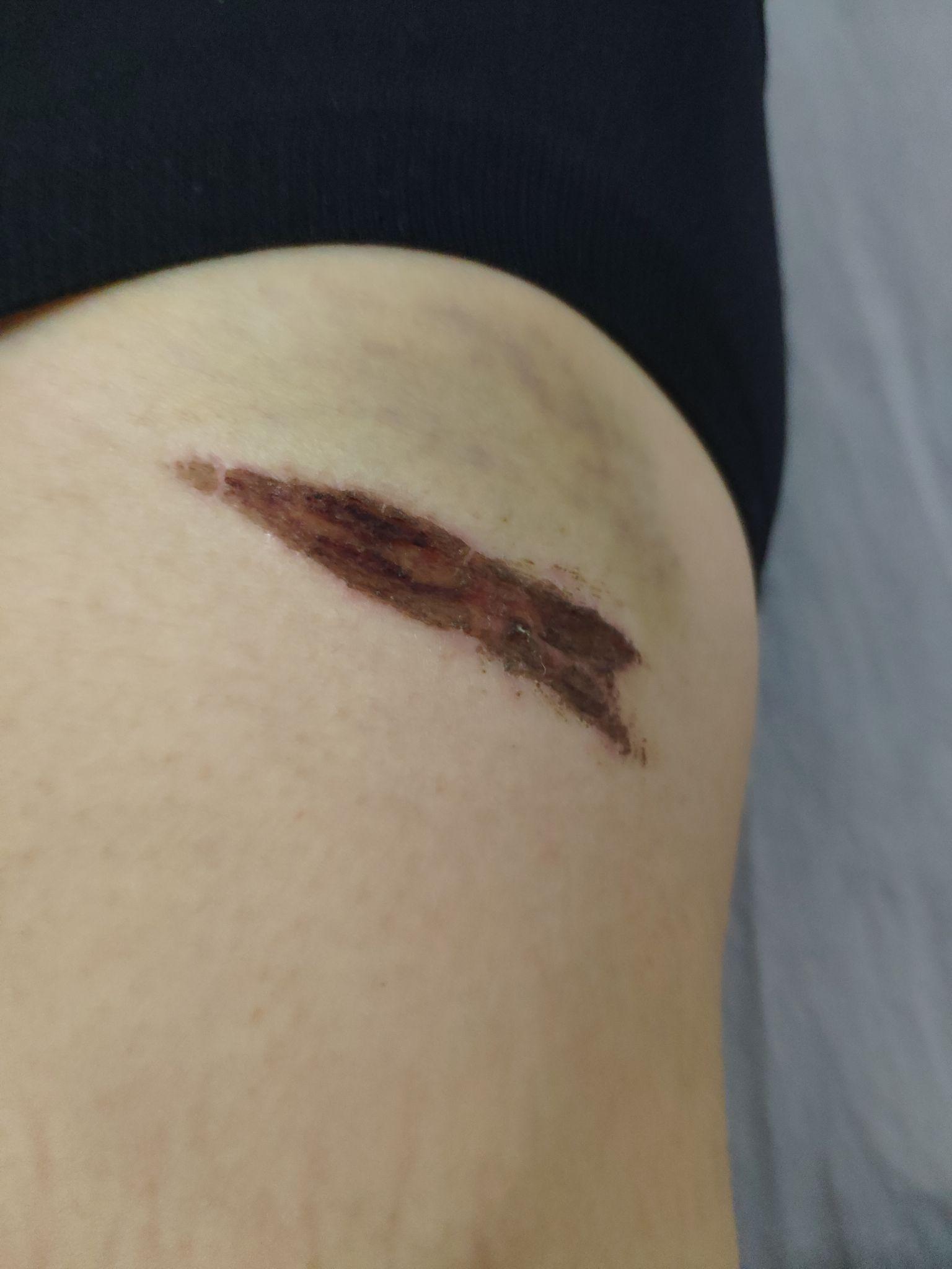 骑车摔倒擦伤怎么快速修复啊? - 知乎