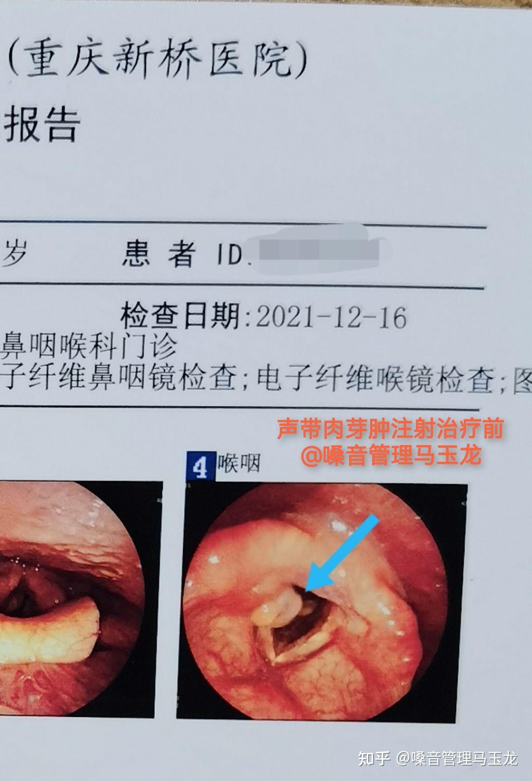声带肉芽肿注射治疗嗓音管理马玉龙