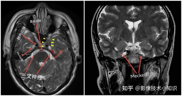 鞍区MRI影像解剖 - 知乎