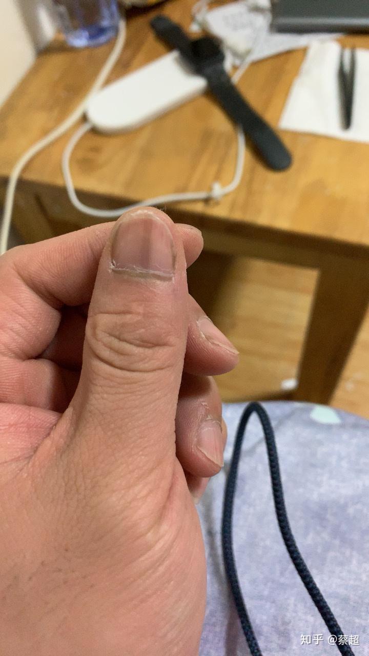 左手大拇指指甲出现一条黑色竖纹,是怎么回事? - 知乎