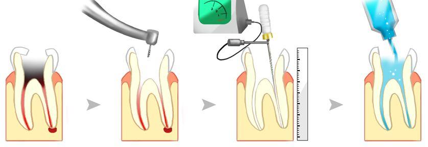 2, 根管预备:包括揭髓顶,进入髓腔,清理坏死组织,扩大根管,冲洗及