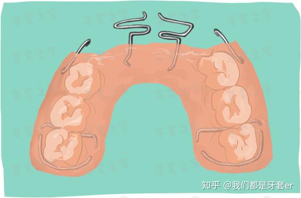 科普|你想了解的正畸装置,可能都在这里!!(正畸牙友们必备收藏) - 知乎