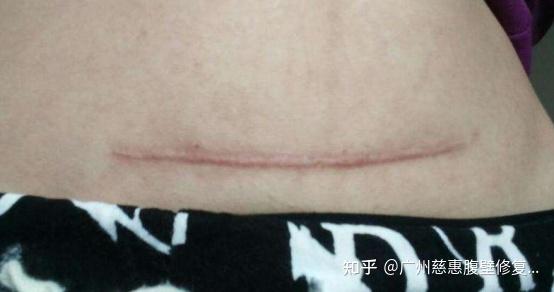 腹壁整形疤痕图片图片