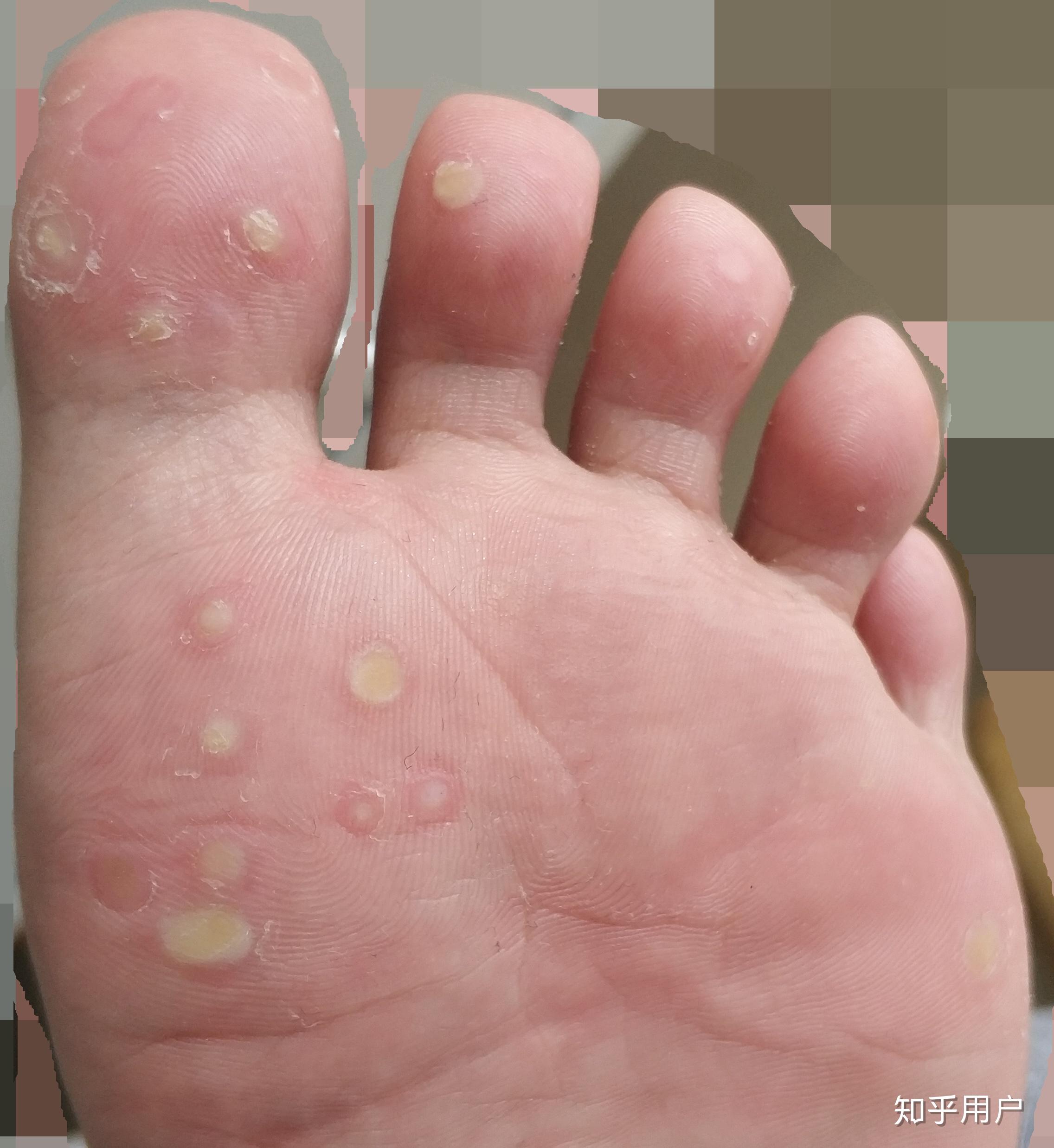 治疗脚上的跖疣各位有没有用过tb上的滴优的,多长时间好的? - 知乎