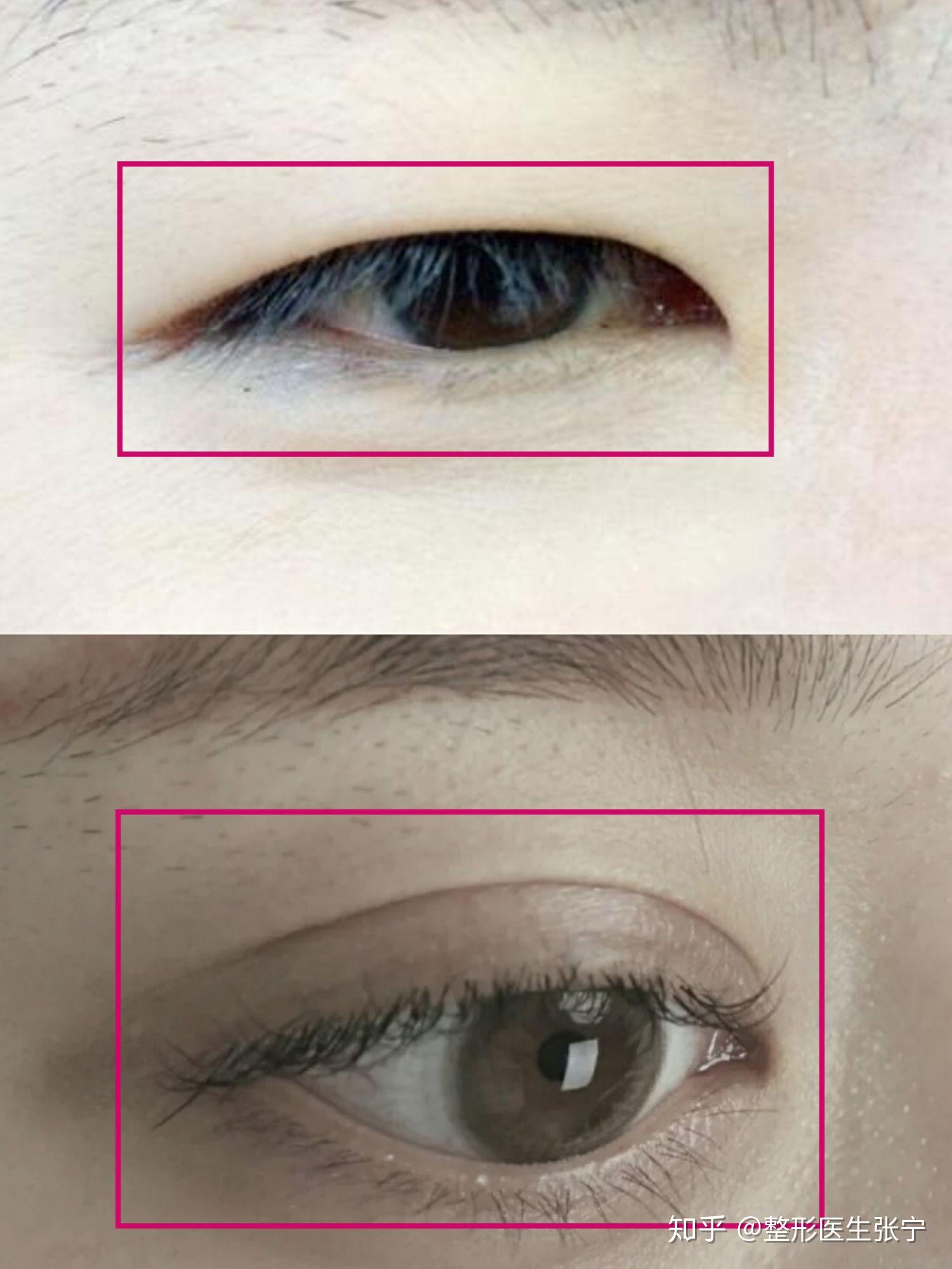 90%的人都喜欢大眼睛，深度分析双眼皮大眼睛的秘密 - 知乎
