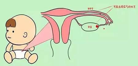 婴幼儿女孩儿腹股沟疝气严重吗