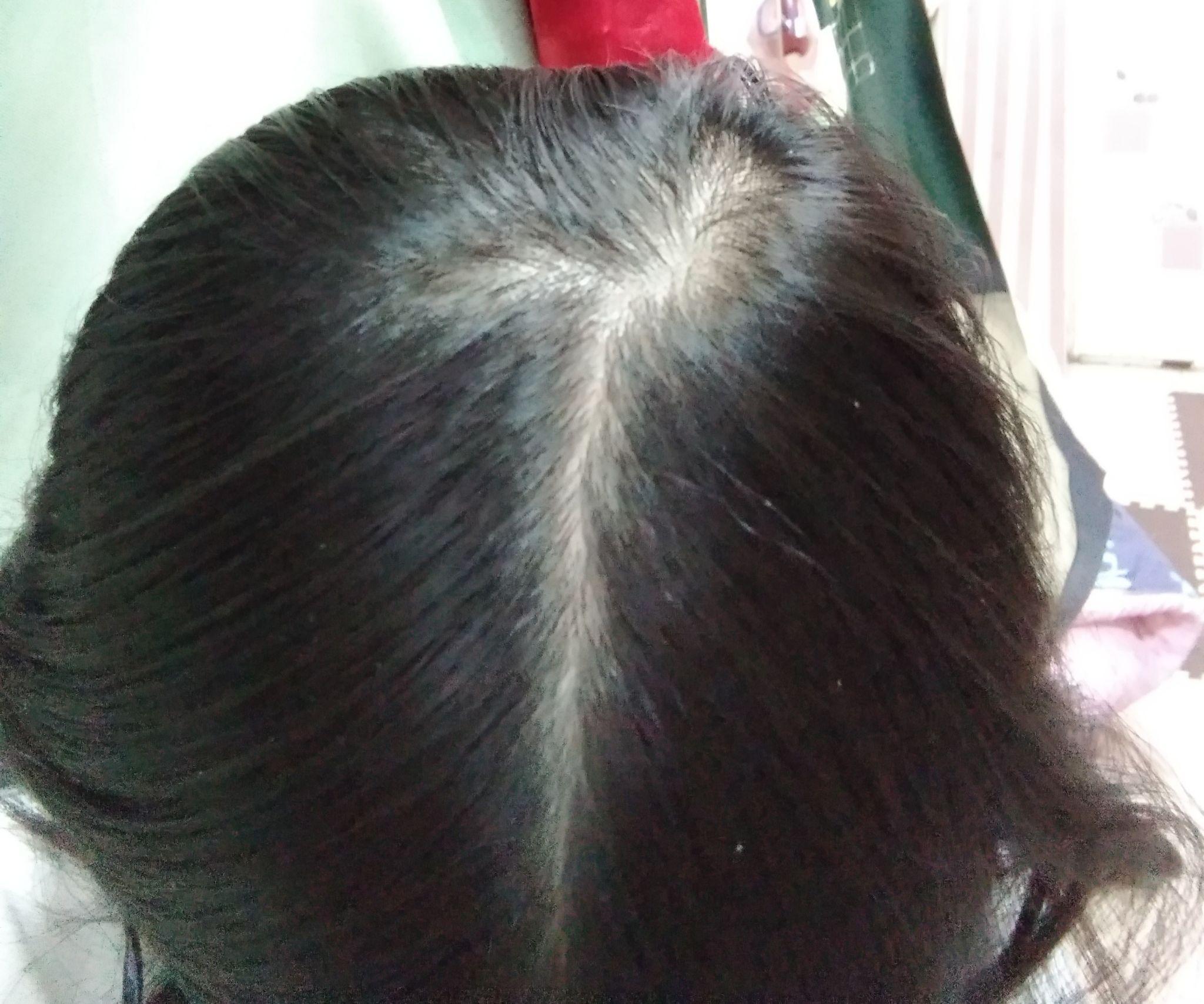 请问女孩子散开头发头顶是这样的算秃吗