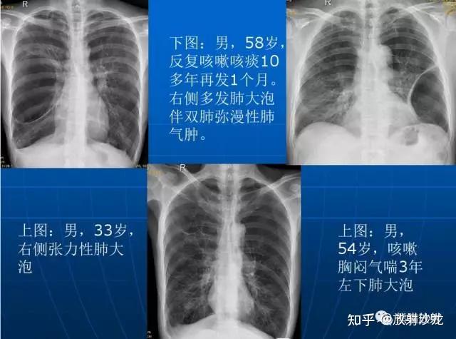 局限性阻塞性肺气肿↓ 间质性肺气肿↓ 慢性阻塞性肺气肿的发病