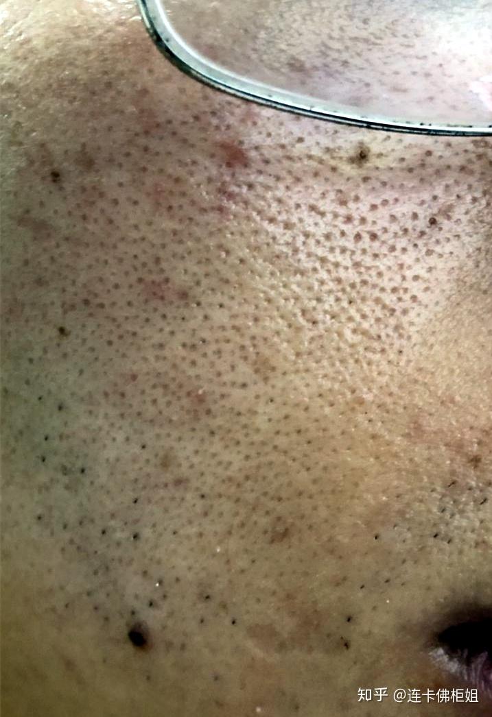 我想知道,去黑头最有效的解决办法是什么,我脸上的黑头毛孔都要难看死