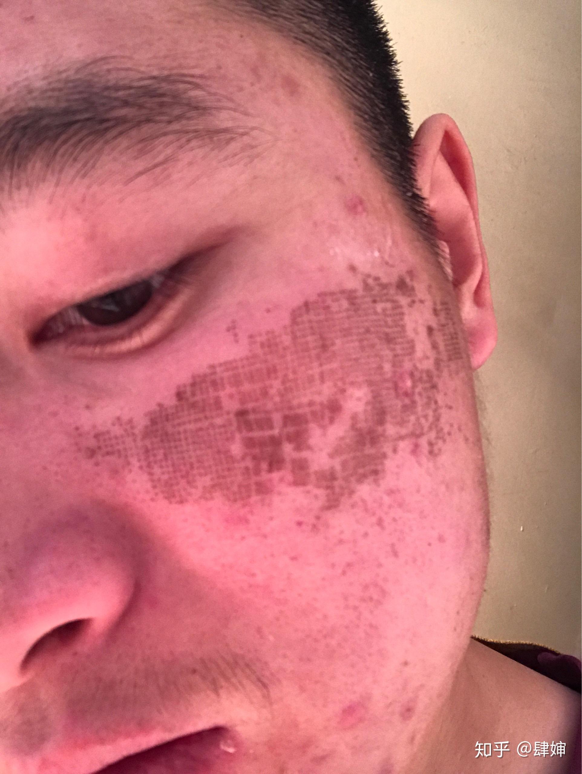 记录下点阵激光治痘坑