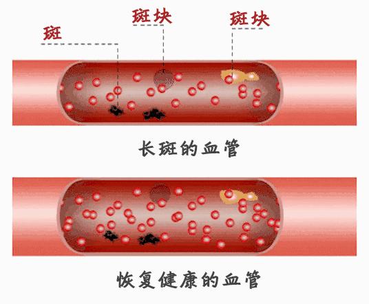 血栓和斑块的区别图片