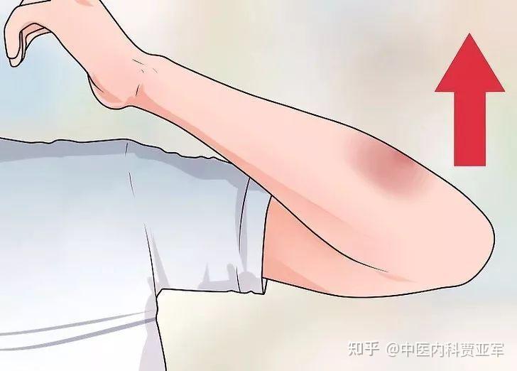 气血的5种“淤”：浊气、痰湿、湿热、瘀血、癌，你在哪个阶段？ - 知乎