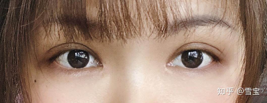 请问开扇型和平行型双眼皮我适合哪个