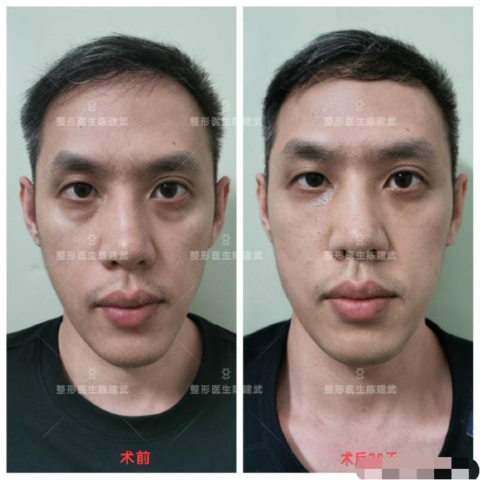 31岁帅哥眼袋手术1个月后 眼袋泪沟没了 黑眼圈淡化明显 知乎 31岁帅哥眼袋手术1个月后 眼袋泪沟没了 黑眼圈淡化明显 知乎