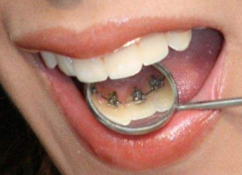 我们戴完牙套之后,视觉上来看牙齿的位置都发生了移动,但是牙根的纤维