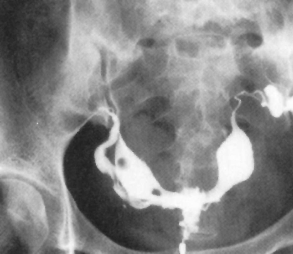 子宫输卵管造影示一个宫颈管,两个宫体图7