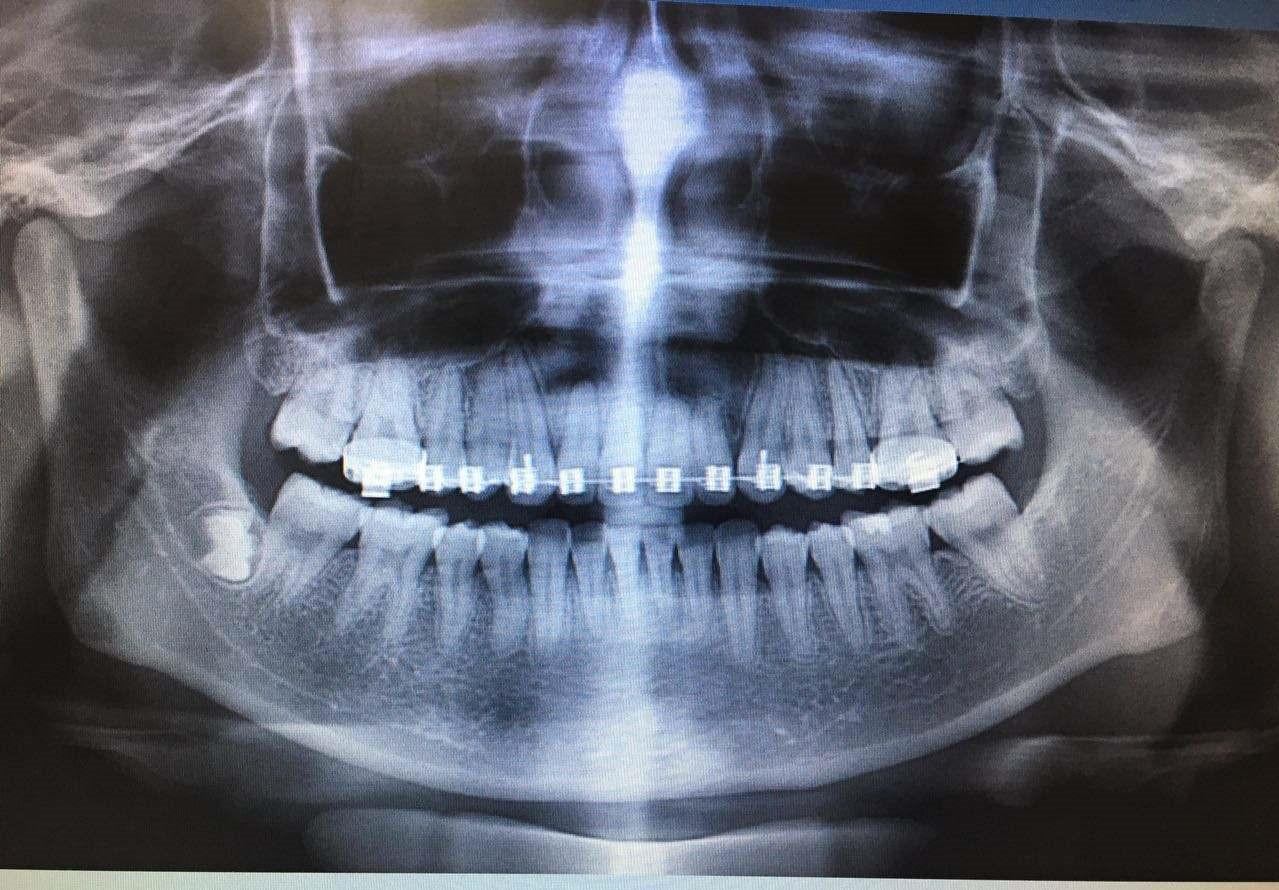 第二节 上颌前部骨切开术-口腔科学-医学