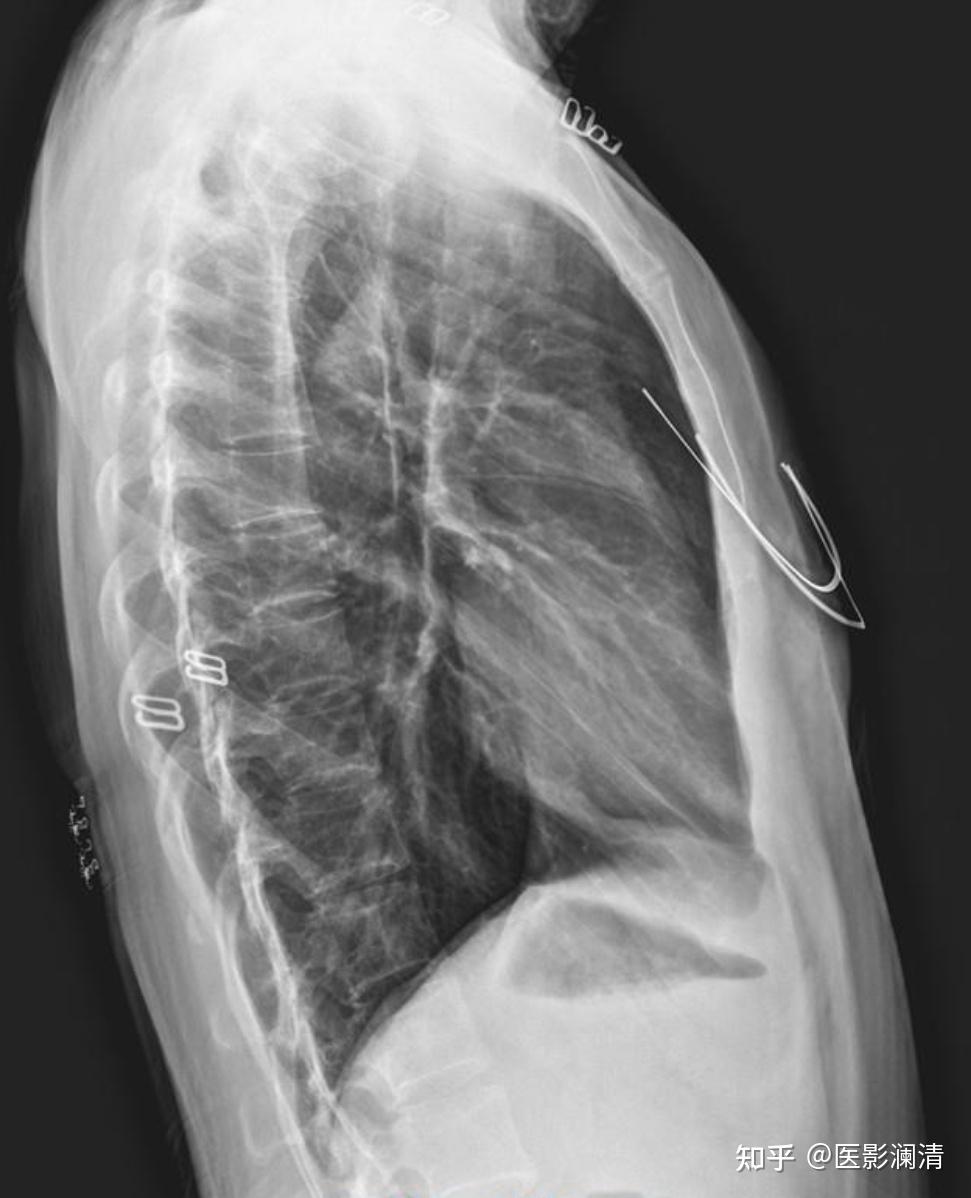 拍x线胸片正侧位? - 知乎