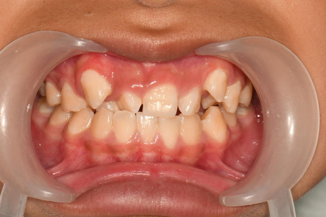 廉江佳雅口腔医院:孩子换牙后,牙齿为什么不整齐