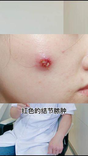 长了汗管瘤该怎么办