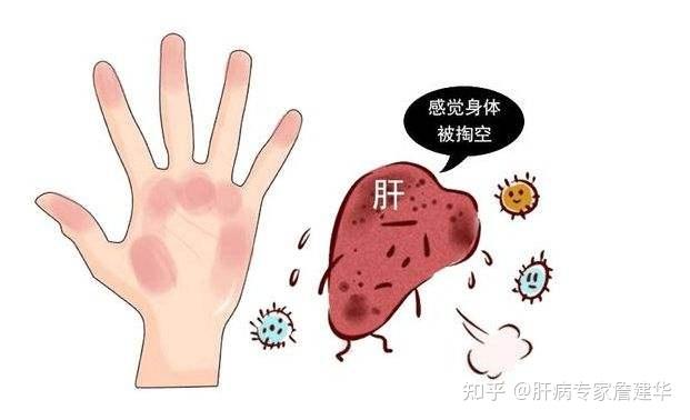 乙肝患者的的明显症状是什么