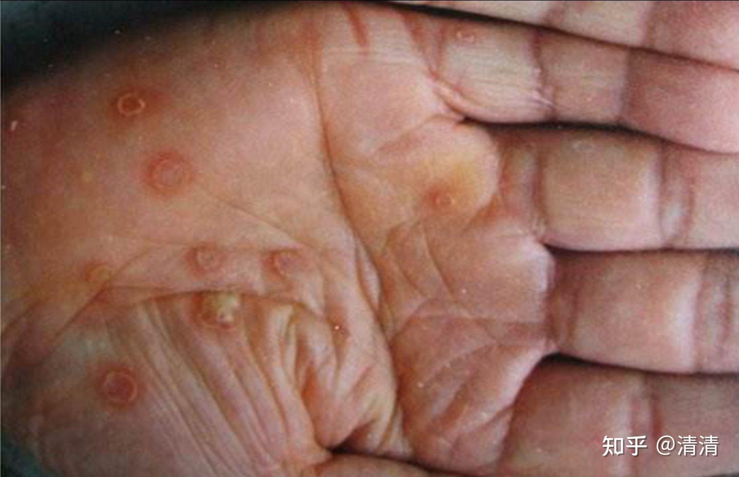 硬下疳是什么病