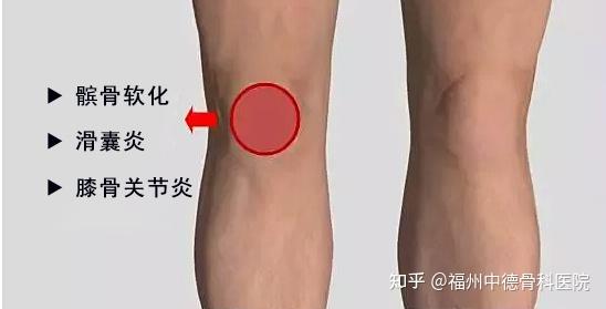 ① 滑囊炎:一般是股四头肌过紧导致膝前方压力过大或撞击后出现,可能