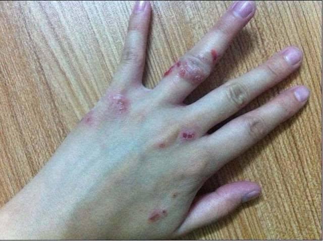 湿毒分四等级,看看你是不是该祛湿了! - 知乎