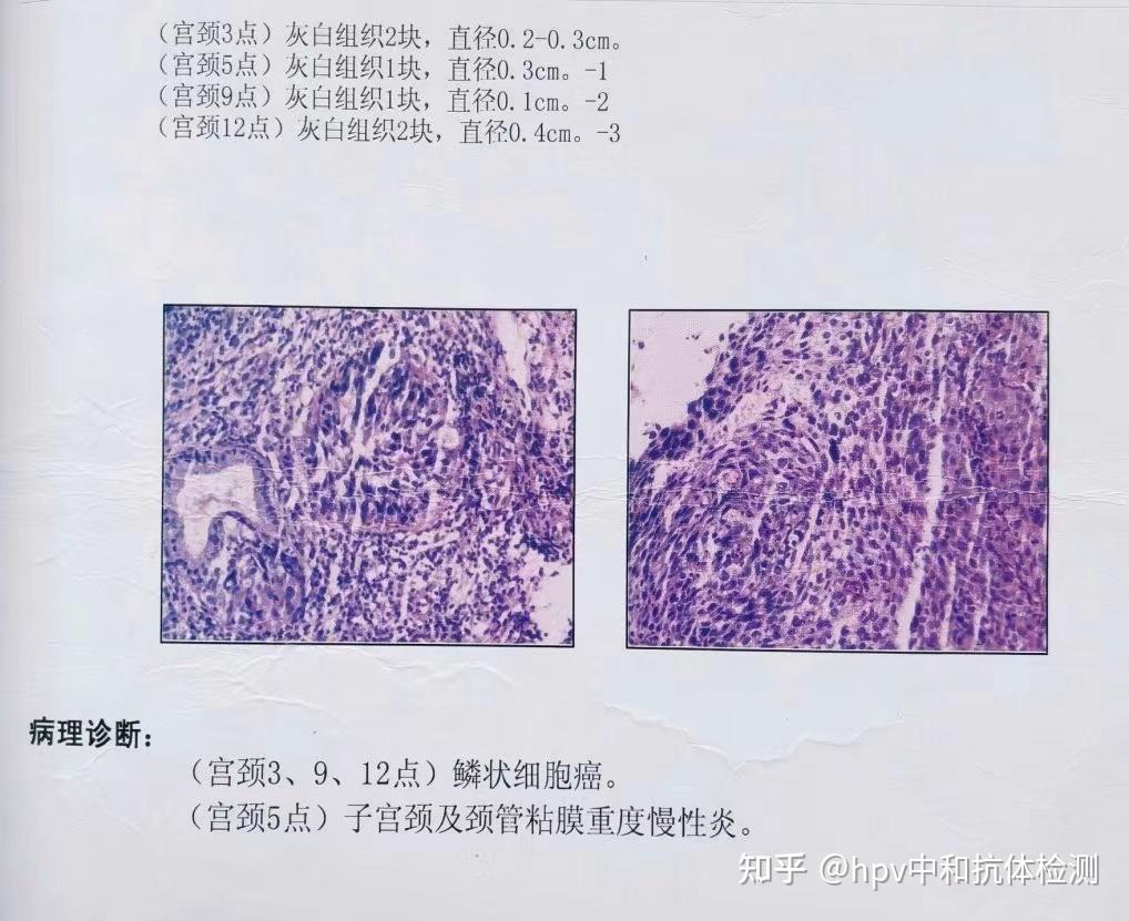 后悔hpv阳性没重视演变成了宫颈鳞状细胞癌