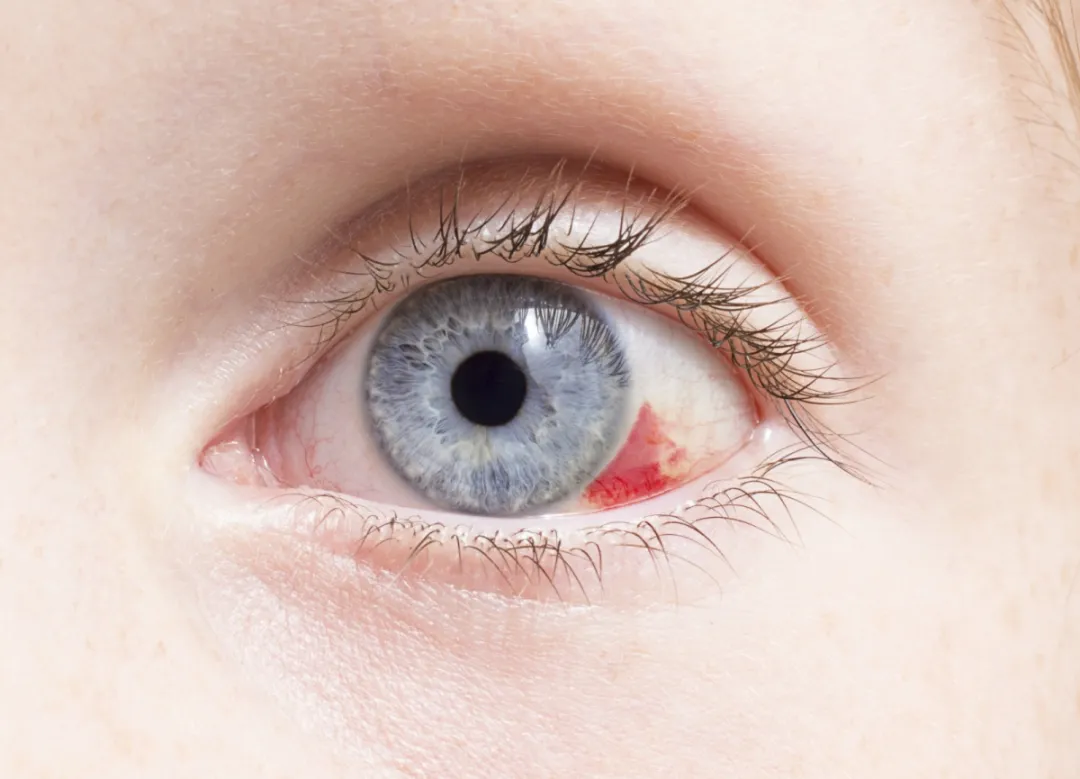 白人女性眼内断裂血管结膜下出血毛细血管破裂的临床观察. 库存照片 - 图片 包括有 经纪, 出血: 215698648