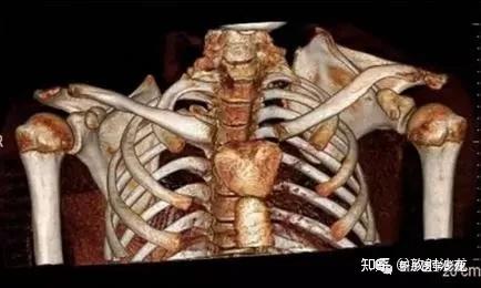 6, 蝴蝶椎概 述:椎体中央脊索退化不全,脊索周围鞘残留或椎体两侧的