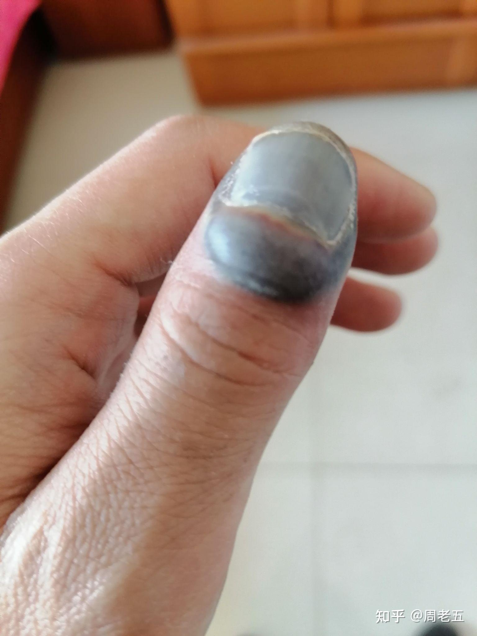 左脚大拇指被重物砸了 指甲内有淤血 特别疼 已经疼了一个晚上了 请问