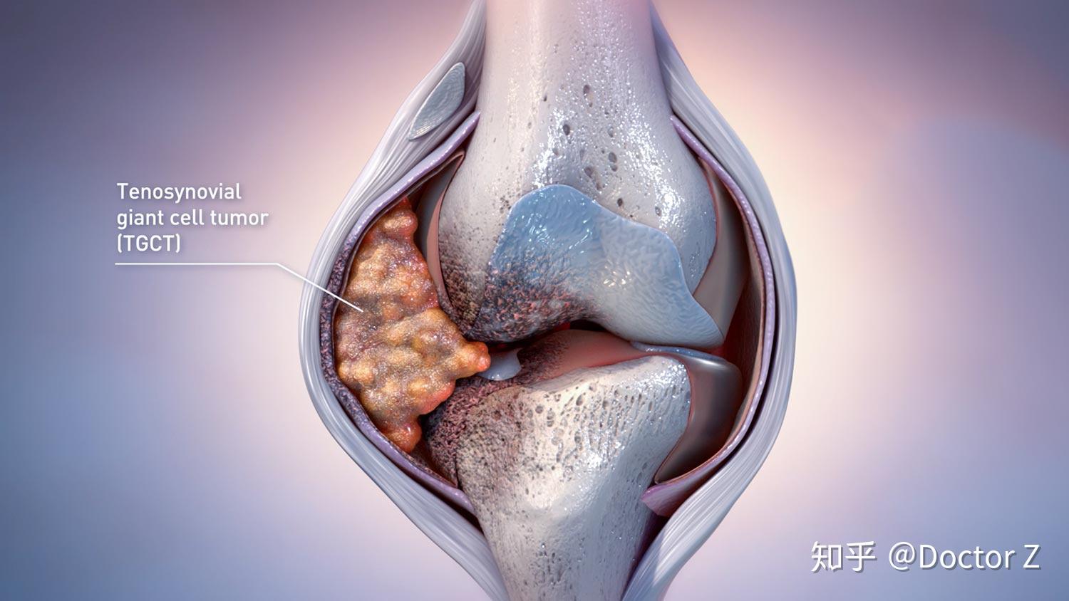 美国fda批准首个罕见关节肿瘤疗法