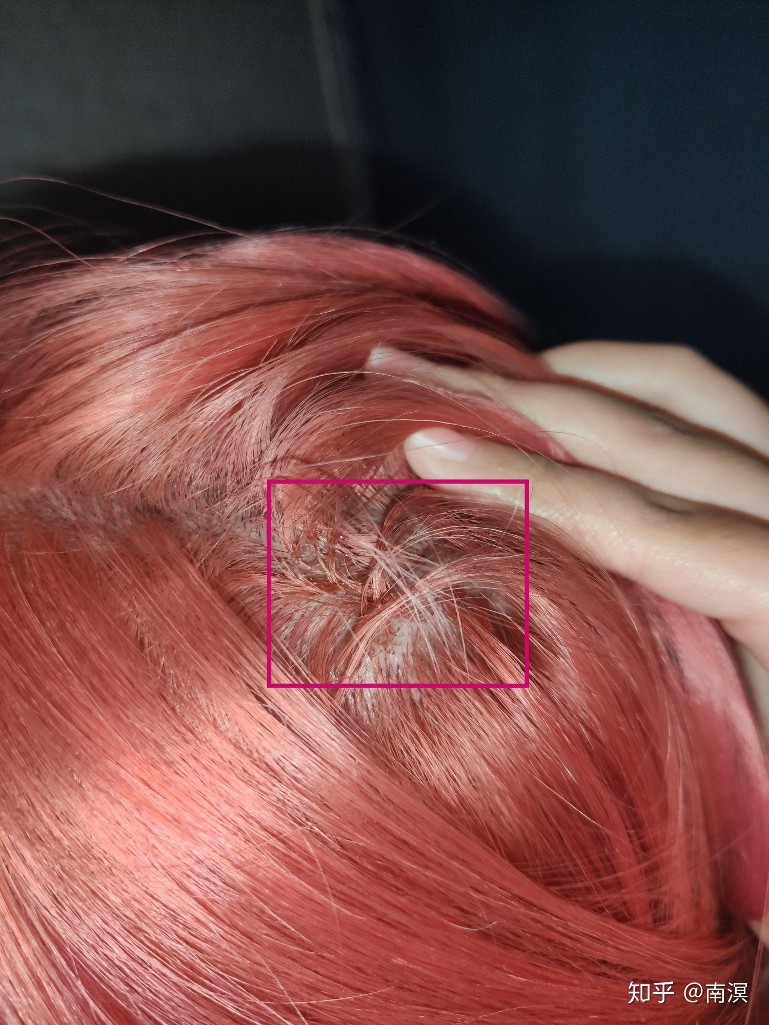 漂头发以后染发过程头皮会不会刺痛第二天会结痂吗