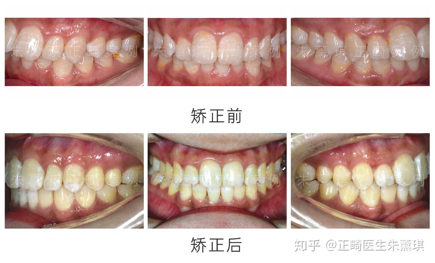 济南牙齿矫正案例丨【智齿牵引矫治】牙齿缺失不用种植系列 - 知乎
