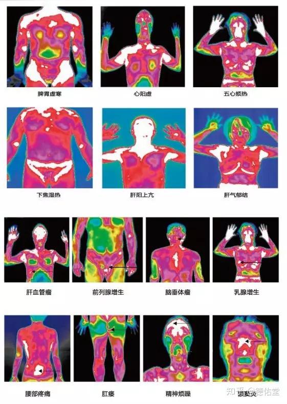 也就是说,医生看到红外热成像之后,看人体哪里颜色红得发紫,哪里就是