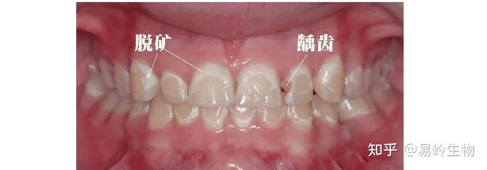 去看牙,发现牙齿脱矿了? - 知乎