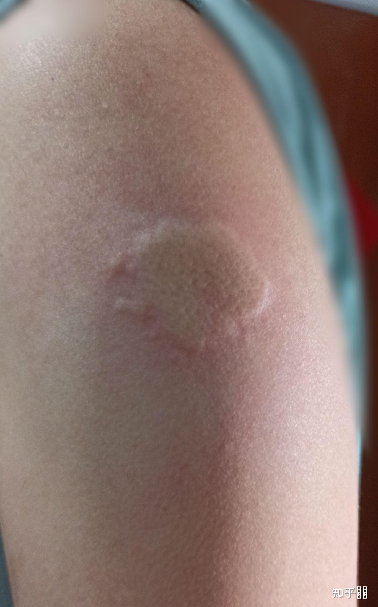 新冠疫苗第二针后左侧腋窝淋巴结肿痛还出现像被蚊子咬的皮疹大家有没