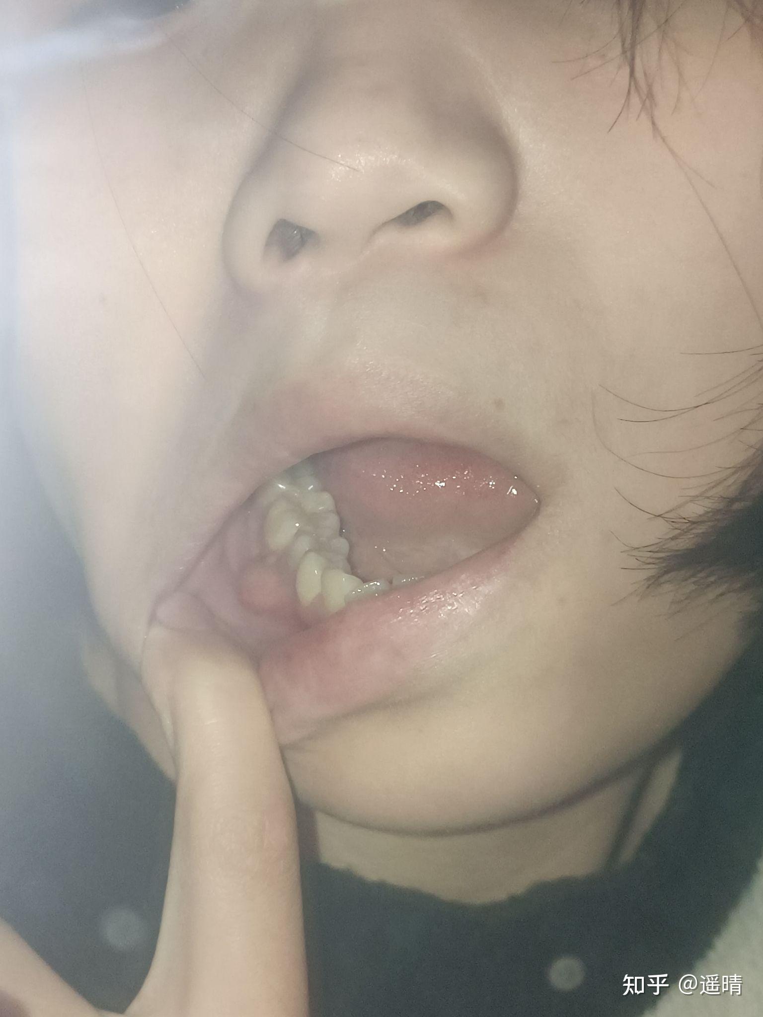为什么牙龈肿了还长了一个白色的东西? - 知乎
