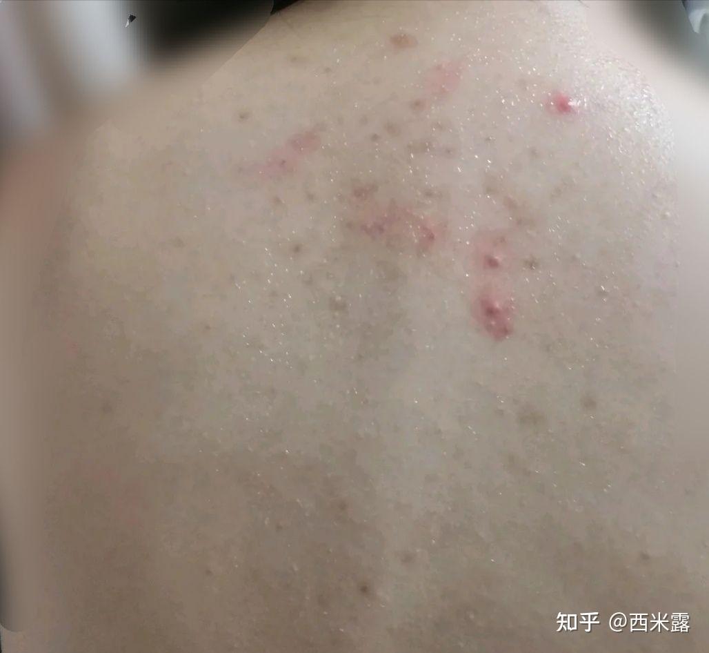 背上长了很多痘痘用什么沐浴露比较好