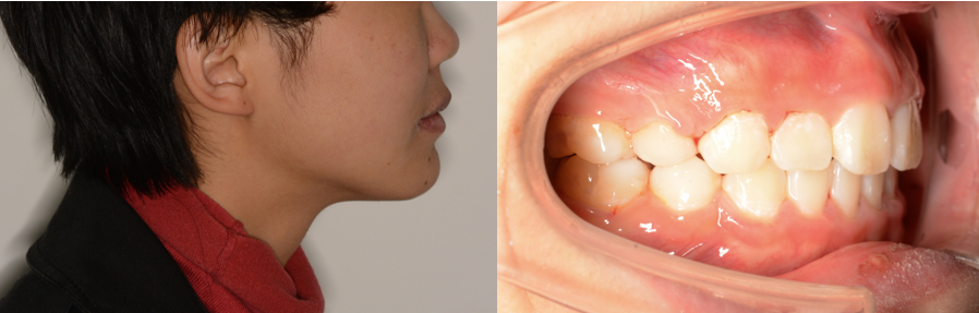 有没有牙齿很整齐咬合也正常单纯因为嘴凸去矫正牙齿的小伙伴? - 知乎