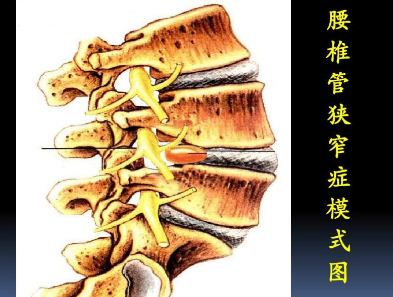 (1)中央型腰椎管狭窄:又称马尾间歇性跛行(2)神经根型腰椎管狭窄:又称