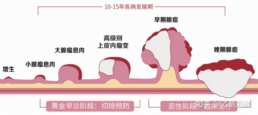 请问肠息肉分型和良恶性判断的关系 知乎