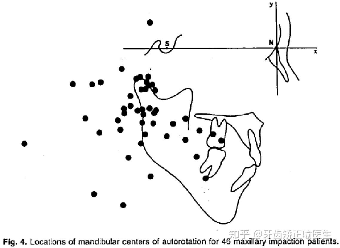 深覆合矫正可以改善下颚角的角度吗