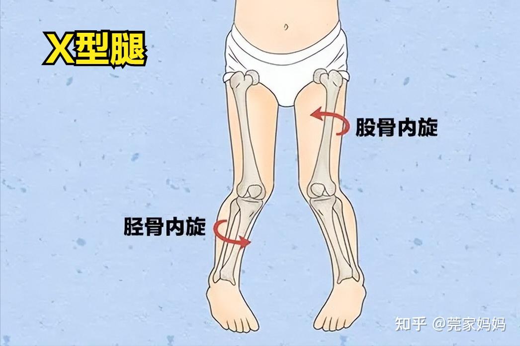 w型坐姿改善o型腿图片