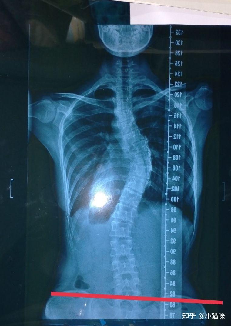 胸椎侧弯希望专业人士解答一下? - 知乎