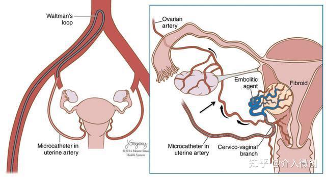 从手上扎针插管就能治疗子宫肌瘤经桡动脉入路子宫肌瘤栓塞术