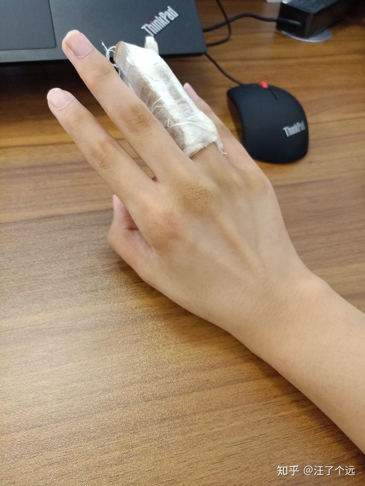 手指头骨折是种怎样的体验? 