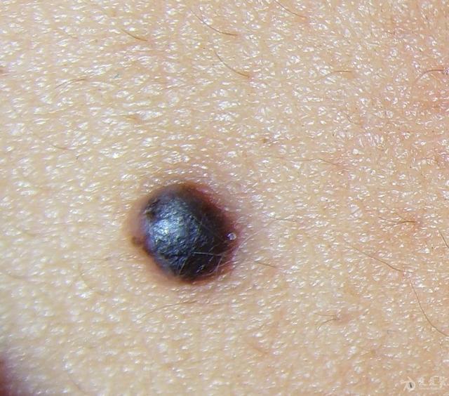 凸起的黑痣可以激光去除吗?